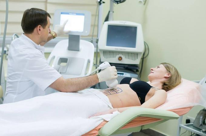 Corps non envahissant contournant la cavitation ultrasonique rf de liposuccion amincissant la machine Liposonix