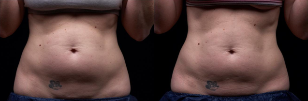 Corps non envahissant contournant la cavitation ultrasonique rf de liposuccion amincissant la machine Liposonix
