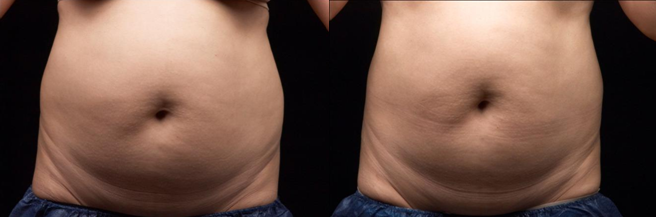Corps non envahissant contournant la cavitation ultrasonique rf de liposuccion amincissant la machine Liposonix