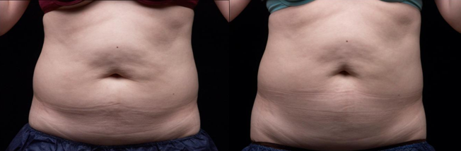 Corps non envahissant contournant la cavitation ultrasonique rf de liposuccion amincissant la machine Liposonix