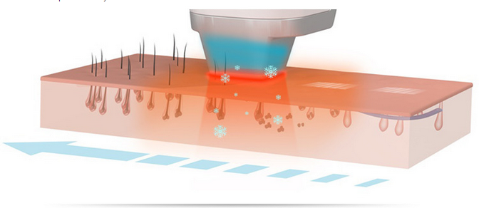 Durée portative d'impulsion de la CE de machine d'épilation de laser de la diode 808nm