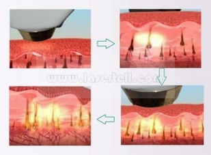 La douleur permanente de machine d'épilation de laser de la diode 808nm libèrent pour la clinique/salon de beauté