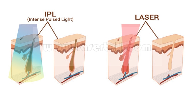 Machine 808nm, équipement cosmétique d'épilation de laser de diode du laser 10Hz