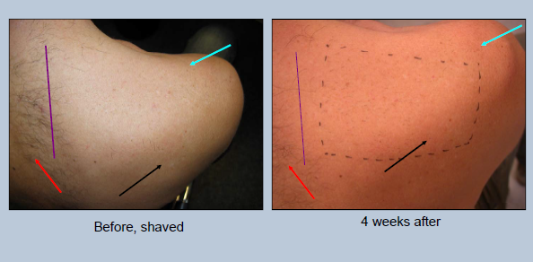 Machine professionnelle d'épilation de laser de diode pour le visage/en dessous/lèvre supérieure