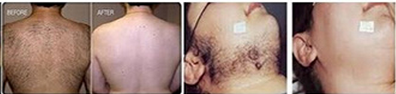 Machine 808nm, équipement cosmétique d'épilation de laser de diode du laser 10Hz