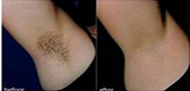 Machine 808nm, équipement cosmétique d'épilation de laser de diode du laser 10Hz