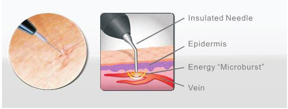 Immédiatement machine de traitement de laser de veines variqueuses de retrait de veine d'araignée de résultat/instruments chirurgicaux vasculaires