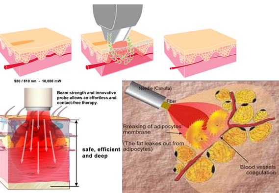 haute fréquence 30MHZ indolore de la diode 635nm de laser d'araignée de veine de machine rouge de retrait