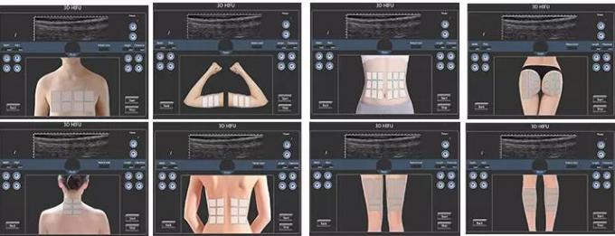Non - tirs envahissants de la machine 15000 de beauté de 150VA Hifu avec l'écran pliable