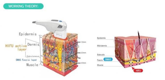 L'intensité portative de la machine 50-60Hz de beauté de Hifu d'ultrason a focalisé l'approbation de la CE