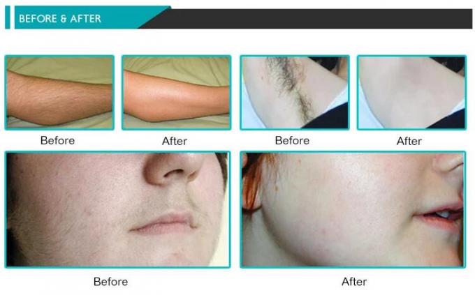 Hairfree 808 longueurs d'onde de la machine 3 de laser de chargement initial de nanomètre pour toute la peau aimable de couleur