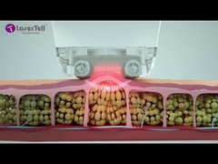 principe de fonctionnement du massage RF sous vide